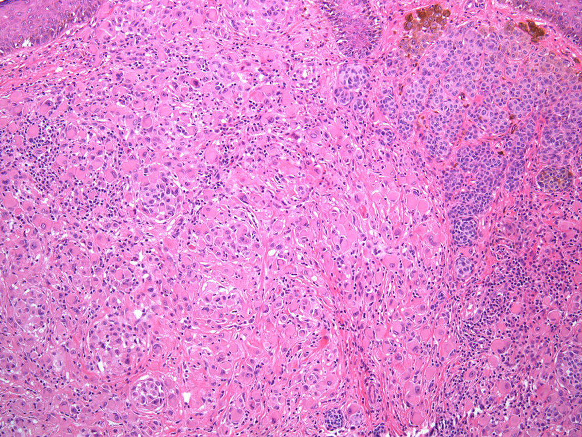 dermatology slide: bap1 nevus with congenital nevus | Cleveland Clinic ...