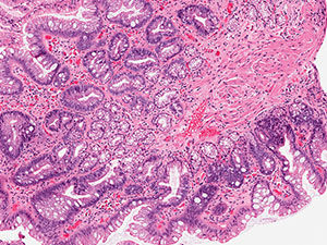 Gastrointestinal Pathology Slide Image - Barrett's Esophagus