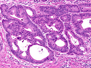 Gastrointestinal Pathology Slide Image - High-Grade Dysplasia