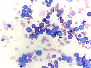 Acute Myeloid Leukemia asp50x