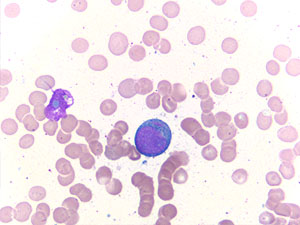 Acute Myeloid Leukemia blast auer2