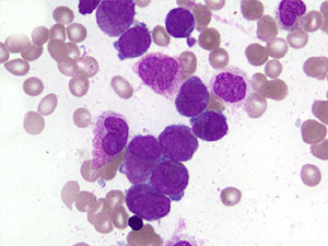 Acute Myeloid Leukemia bm1