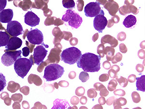 Acute Myeloid Leukemia bm2