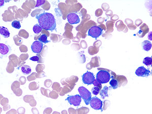 Acute Myeloid Leukemia bmasp2