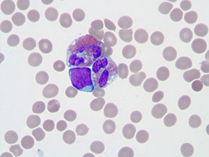 Acute Myeloid Leukemia t(8;21) with eosinophilia