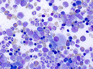 Myeloproliferative neoplasm BM WG 50x 8