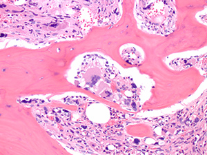 Myeloproliferative neoplasm BX HE 20x 4
