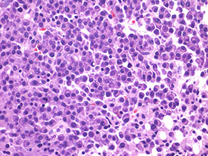 Plasma Cell Myeloma myelomabx