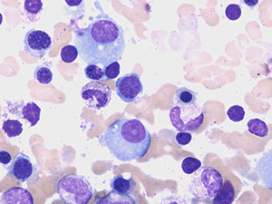 Plasma Cell Myeloma nucl1