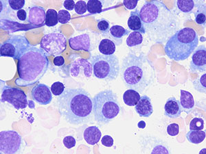 Plasma Cell Myeloma nucl2