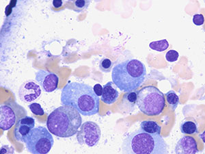 Plasma Cell Myeloma nucl3