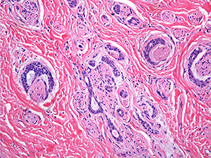 Adenoid cystic carcinoma perineural invasion