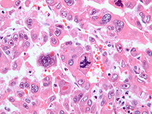 Hepatobiliary pathology slide image
