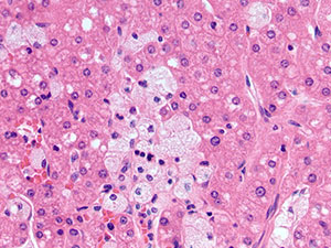 Hepatobiliary pathology slide image