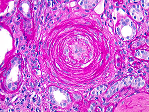 Medical Kidney Pathology slide image