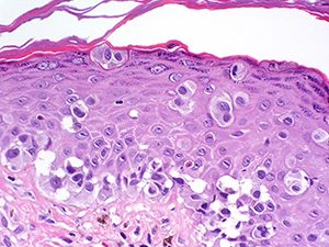 Melanoma - pagetoid spread