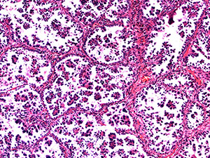 Micropapillary lung adenocarcinoma