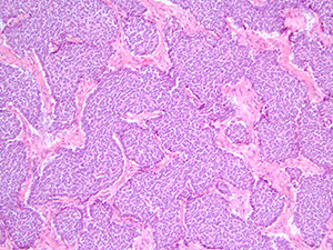 Myoepithelial carcinoma - soft tissue