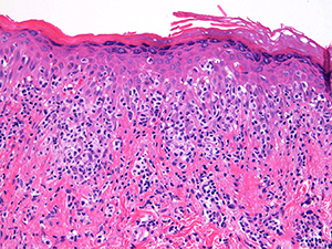 Pagetoid reticulosis 200